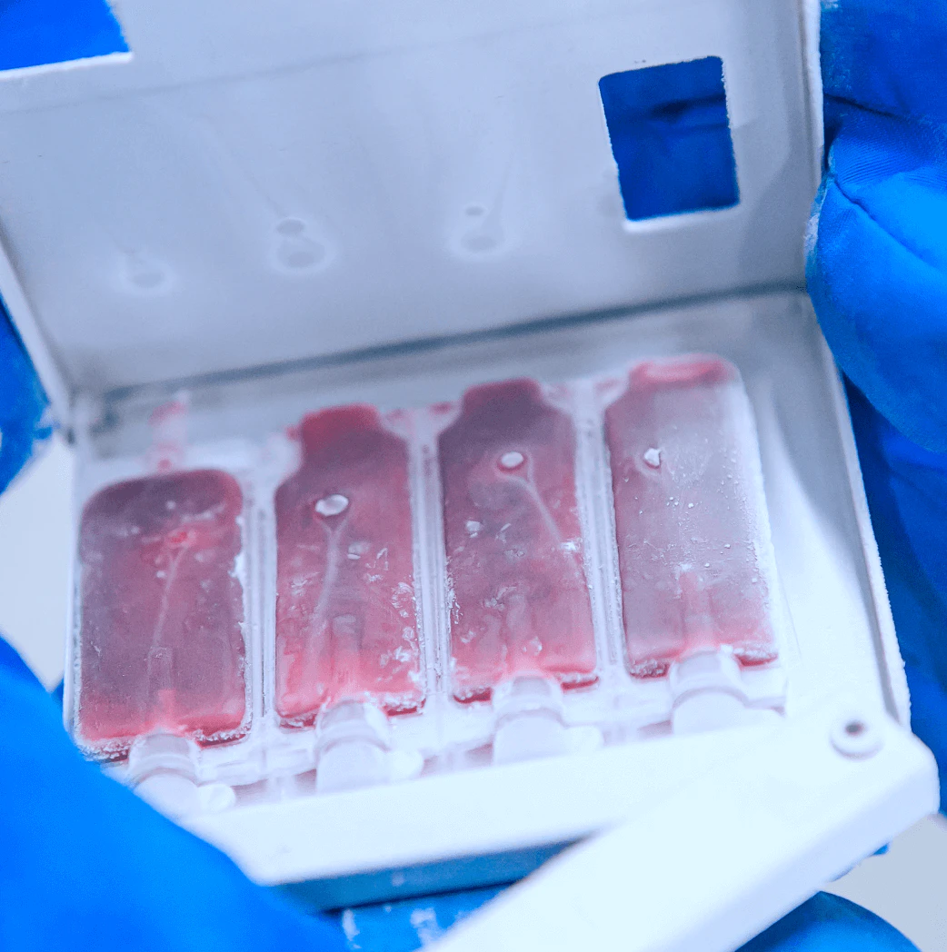 Bolsa de criopreservação tetrapartida aberta mostrando quatro compartimentos individuais com sangue de cordão umbilical congelado em tons rosados, armazenada em recipiente térmico azul para preservação de células-tronco